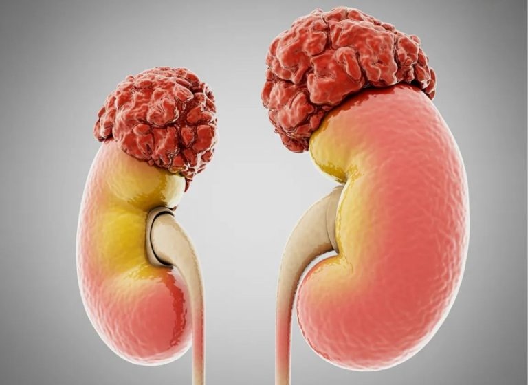 6 Early Common Signs of Adrenal Cancer To Know