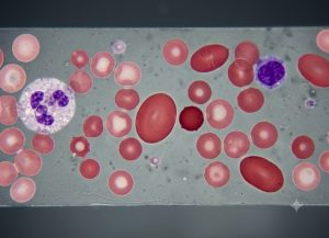 7 Causes of Anisocytosis and What They Mean for Your Blood
