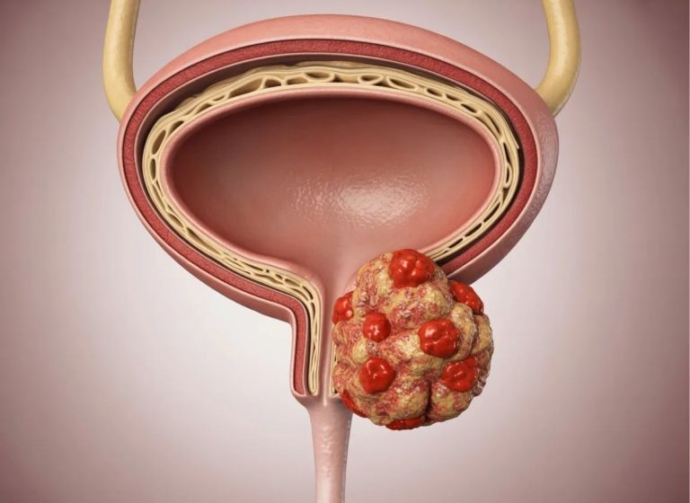 6+ Bladder Cancer Risk Factors: Who Is Most Likely to Be Affected