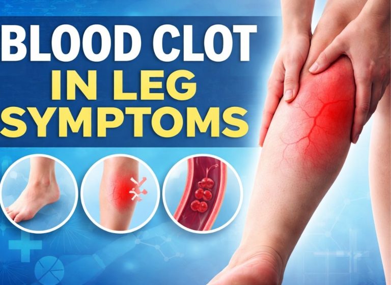 8 Blood Clot in Leg Symptoms That May Point to DVT (Deep Vein Thrombosis)