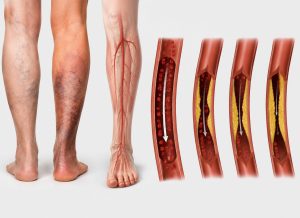8 Peripheral Vascular Disease Symptoms That Signal Poor Leg Circulation