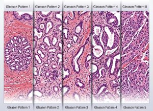 What a High Gleason Score Means for Prostate Cancer