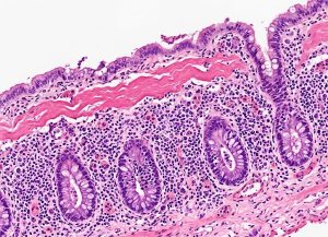10 Things to Know About Microscopic Colitis and Chronic Diarrhea