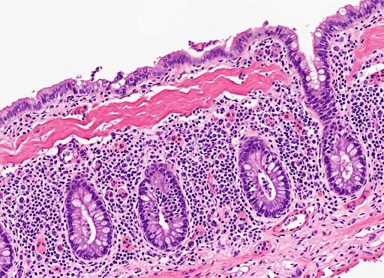 10 Things to Know About Microscopic Colitis and Chronic Diarrhea