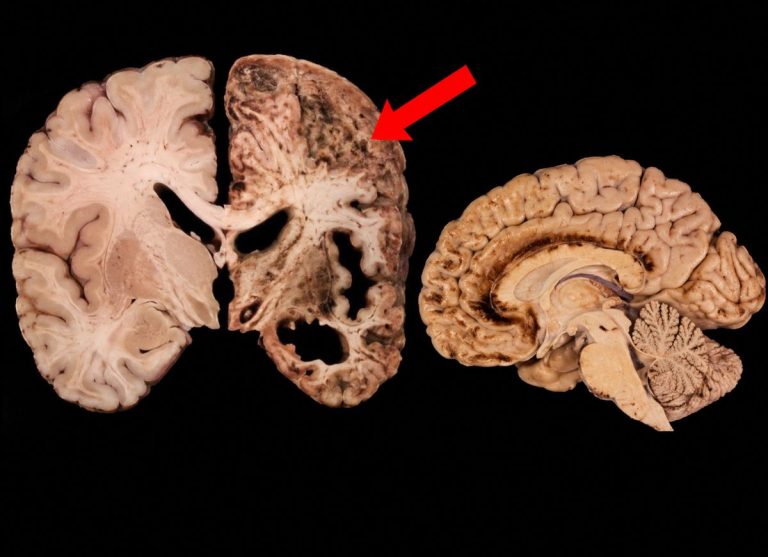 10 Signs of Chronic Traumatic Encephalopathy (CTE) to Know
