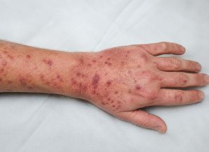 10 Common Symptoms of Eosinophilic Granulomatosis with Polyangiitis