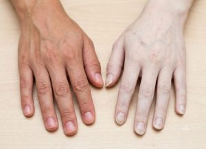 Aplastic Anemia Symptoms and Warning Signs