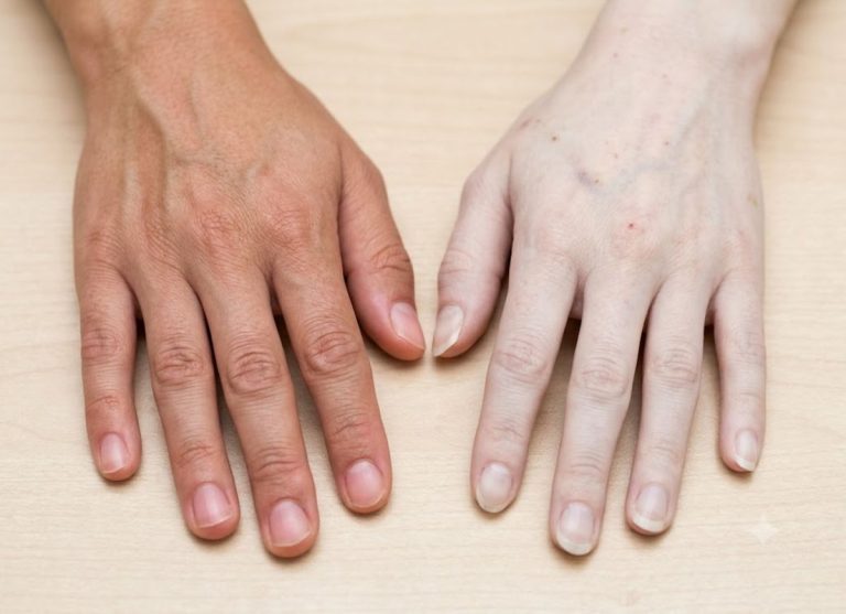 Aplastic Anemia Symptoms and Warning Signs
