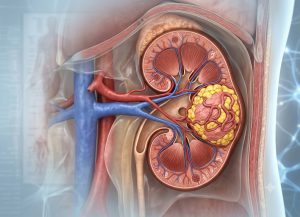 Kidney Angiomyolipoma: Symptoms, Risks, and Treatment Options