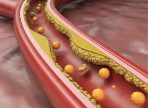 6 Causes of Hyperlipidemia and How It Affects Your Heart