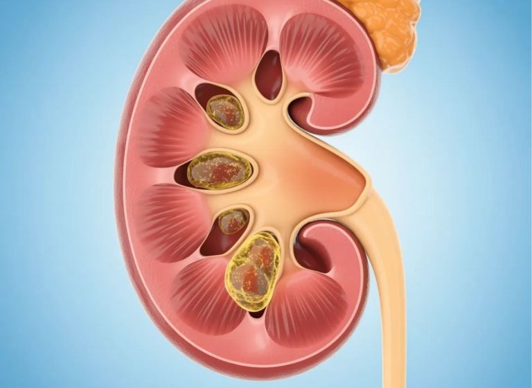 5+ Symptoms, Causes, Pain Patterns of Kidney Stones, and How to Prevent Them Effectively