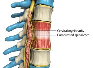 6 Causes of Myelopathy Disease and How It Affects the Spine