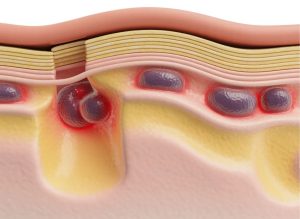 5 Early Symptoms of Panniculitis and When to See a Doctor