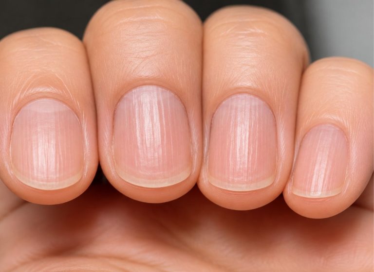 7+ Causes of Ridges on Fingernails and What They May Mean