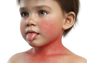 7 Symptoms of Scarlet Fever Disease Every Parent Should Know