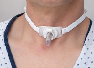 Tracheostomy Procedure Guide: What to Expect, Risks, and Recovery