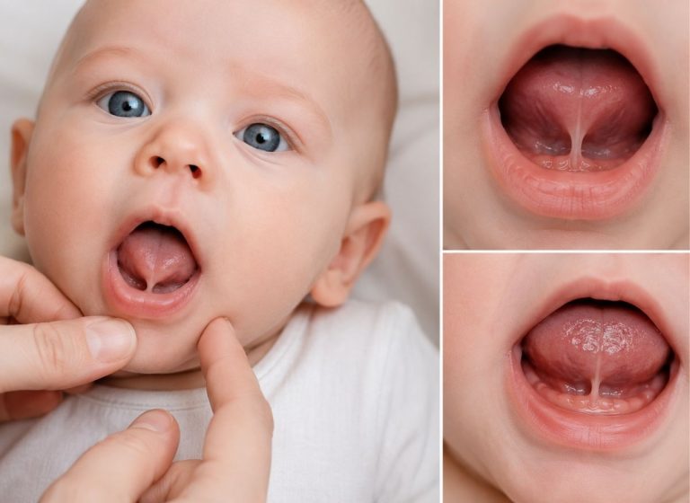 Tongue Tied Baby: 8+ Symptoms, Diagnosis, and Treatment Options